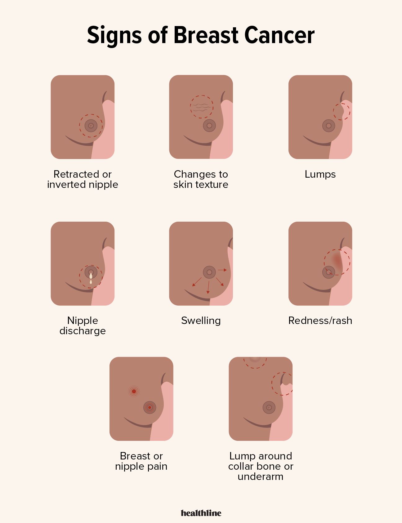 Illustration highlighting early signs of breast cancer