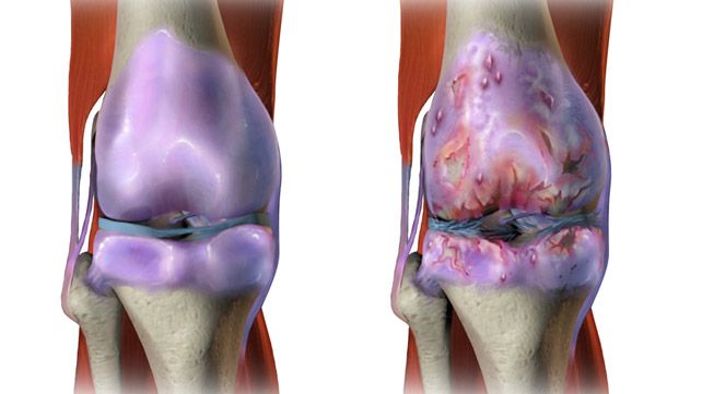An illustration of osteoarthritis in the knees.