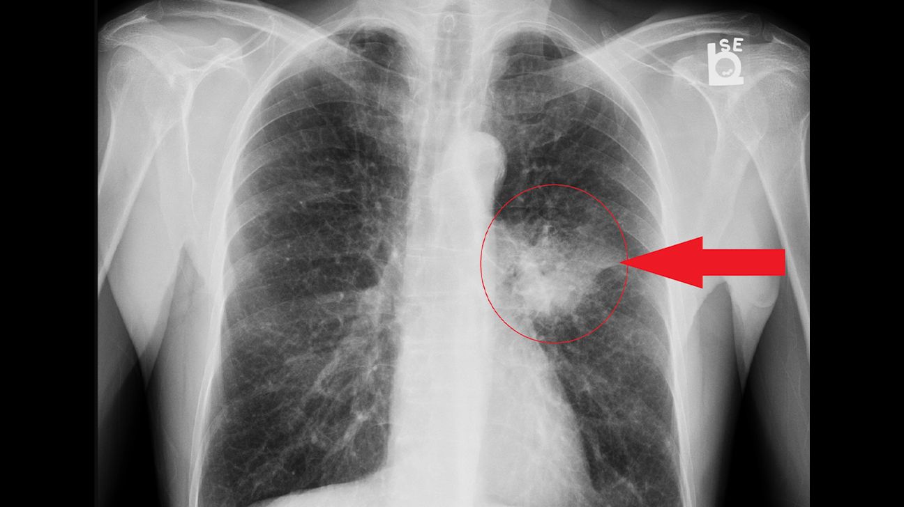 X-ray of lung adenocarcinoma