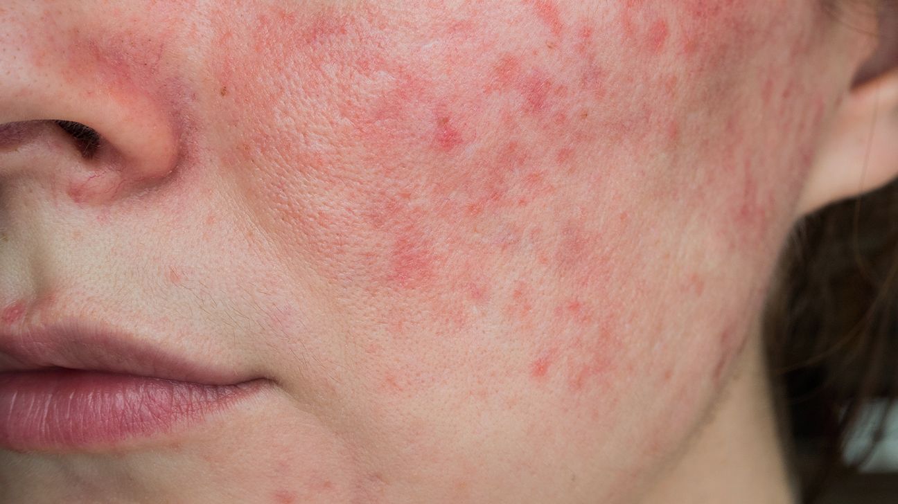 Rosacea Flare-Up Last: Duration, Management, and Prevention