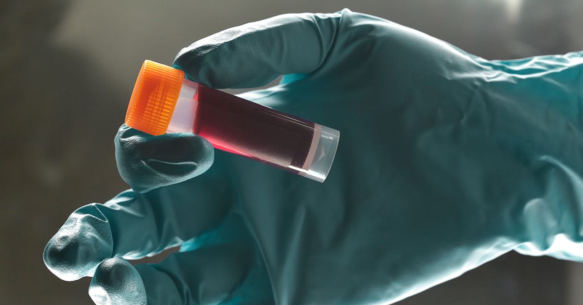 Triglyceride level test: procedure, preparation, and risks