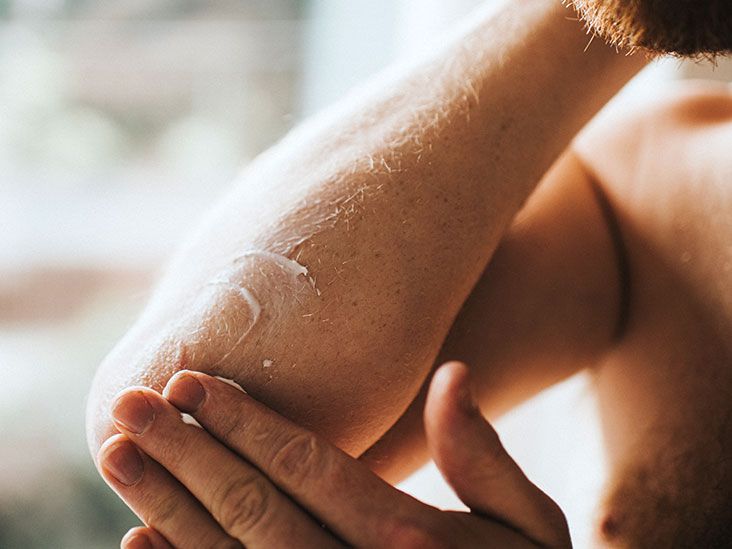 Annular Psoriasis: Symptoms, Causes, and Treatment Options