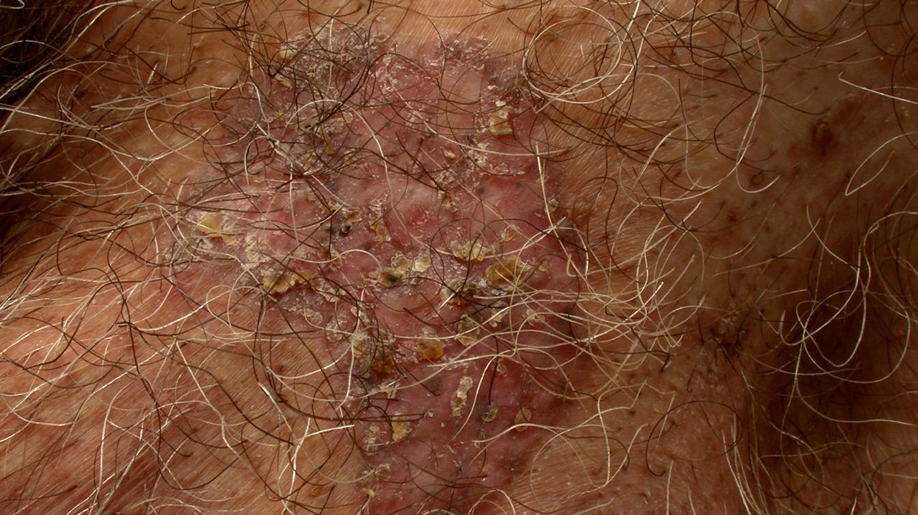 Types of Basal Cell Carcinoma: Appearance, Diagnosis, Outlook
