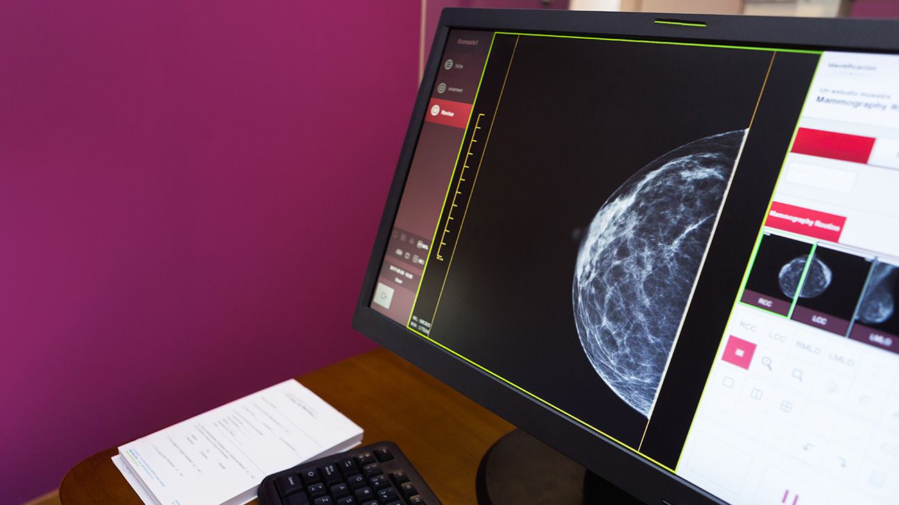 Mammogram scan on a computer monitor