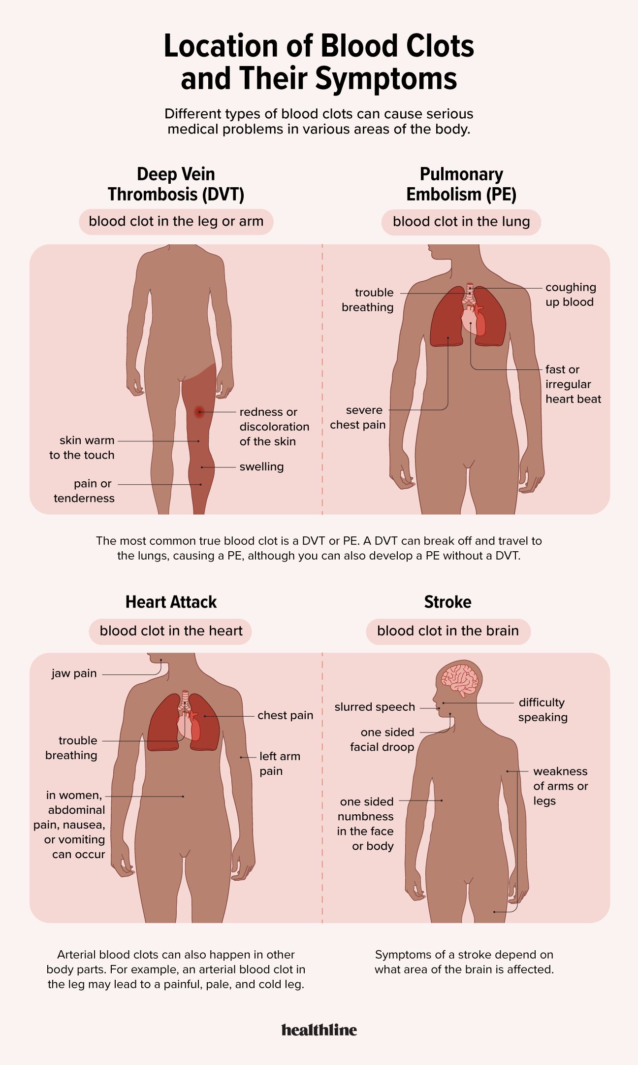 infographic describing symptoms and locations of blood clots