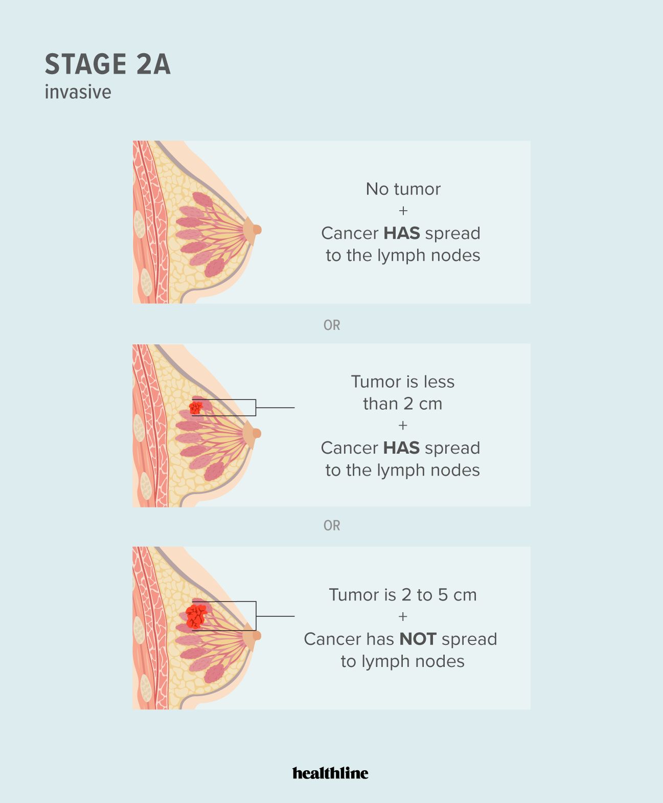 Illustration of stage 2A breast cancer characteristics