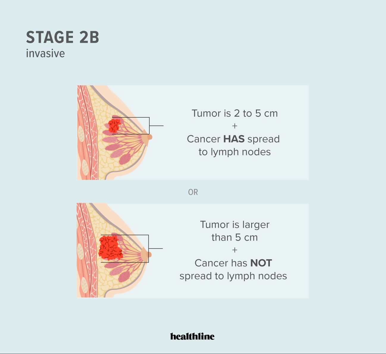 Illustration of stage 2B breast cancer characteristics