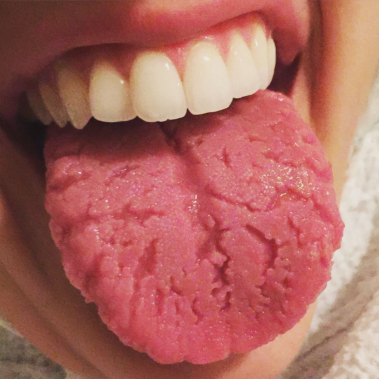 Tongue Cracks: Symptoms and Causes