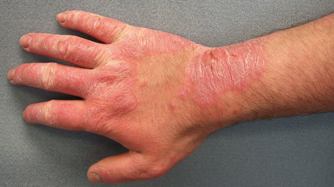 scaly skin from irritant contact dermatitis on the hands