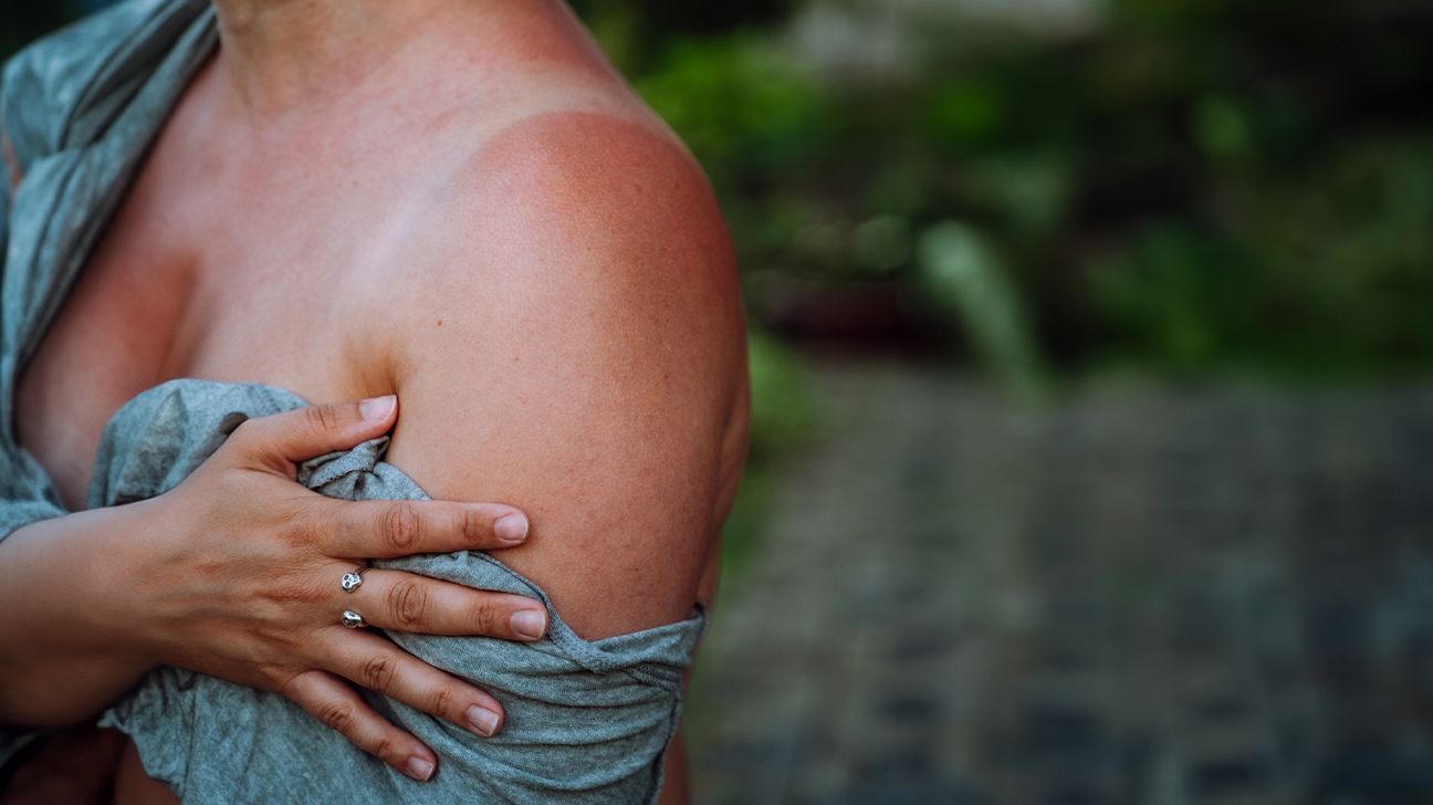 A woman touching her sunburnt shoulder.