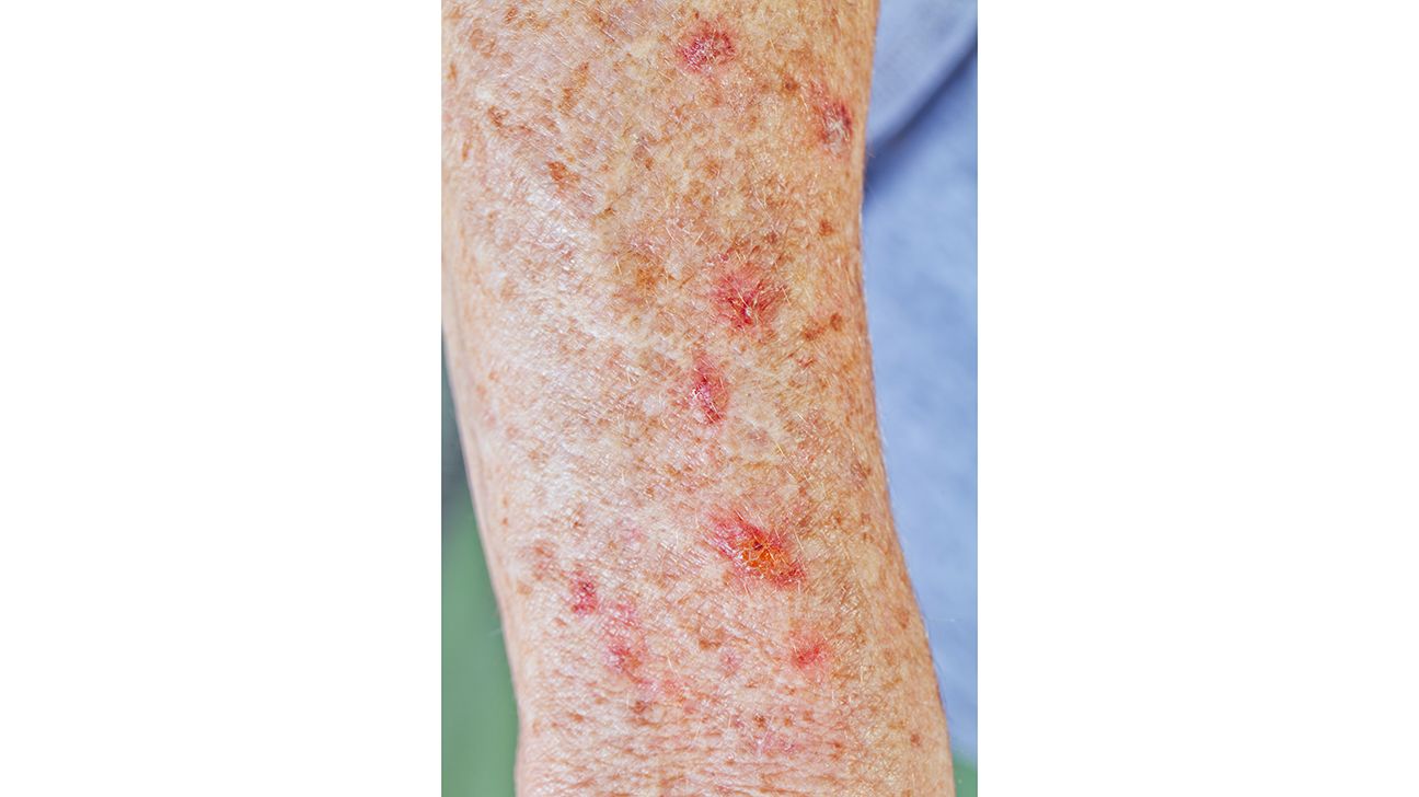 actinic keratosis