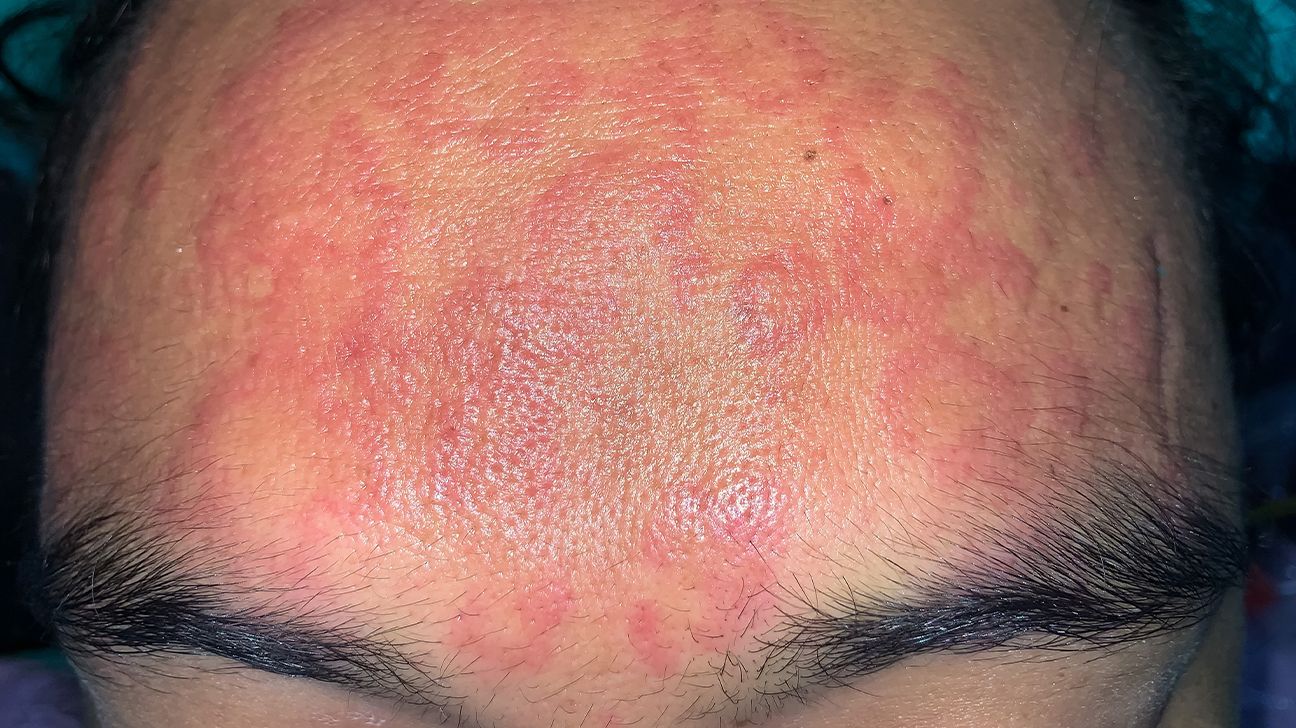 drug allergy causing hives on the face