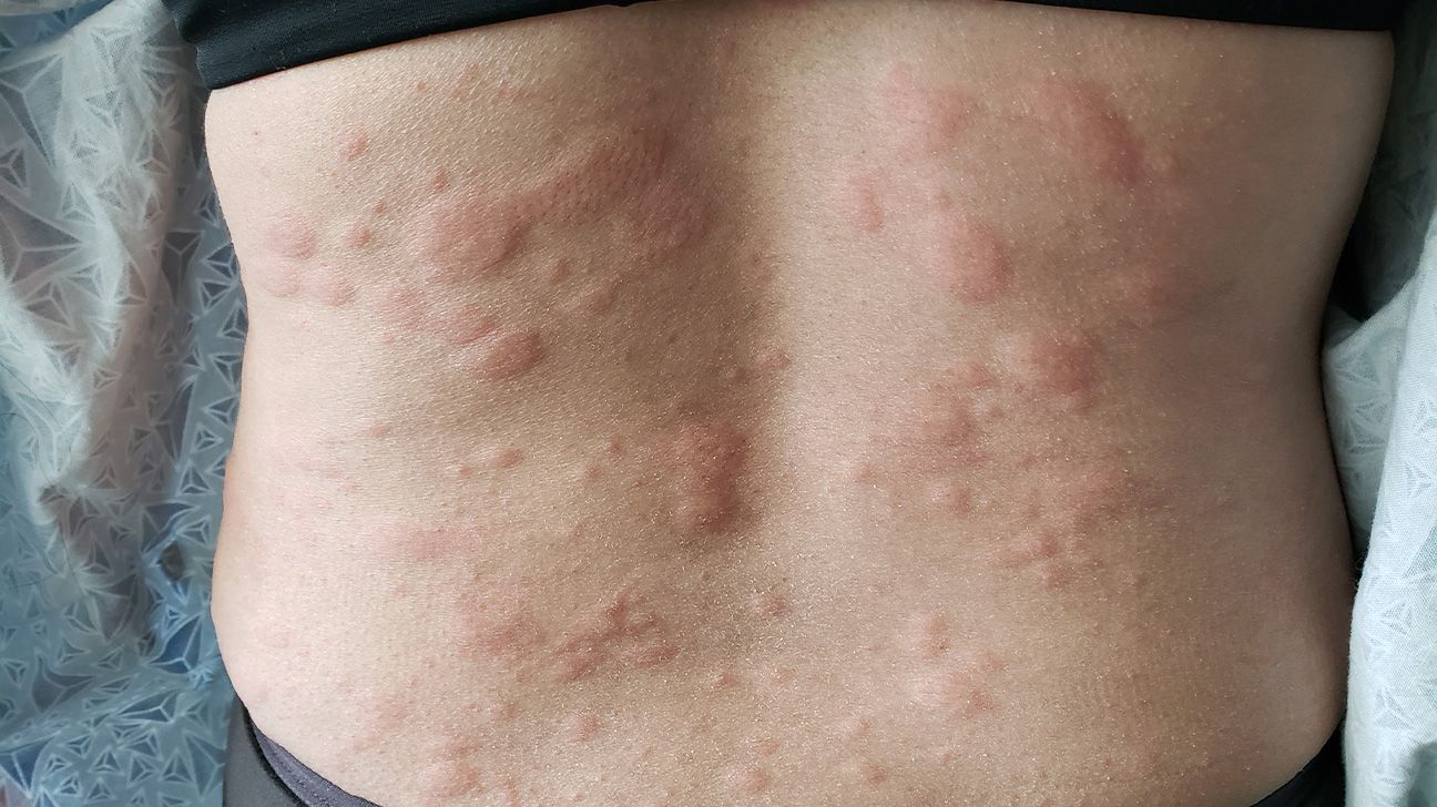 Hives on a person's back