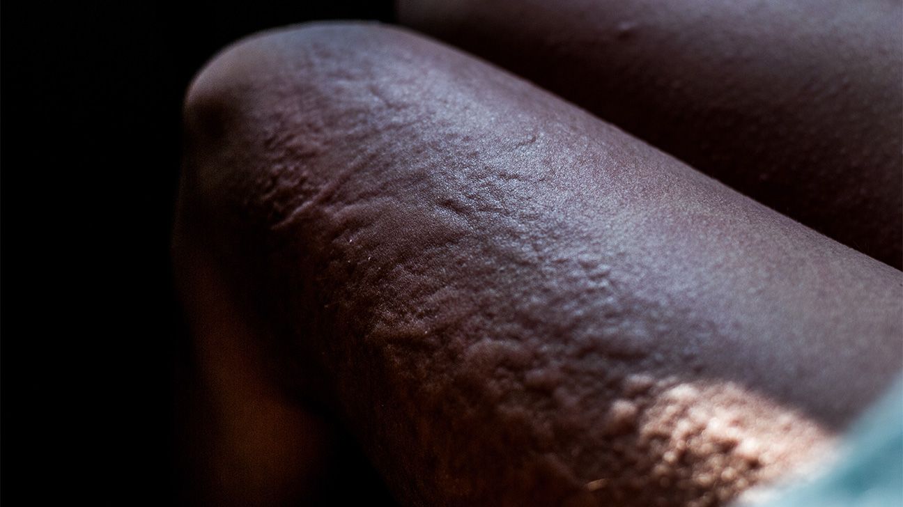 Hives on skin of color due to an allergic reaction