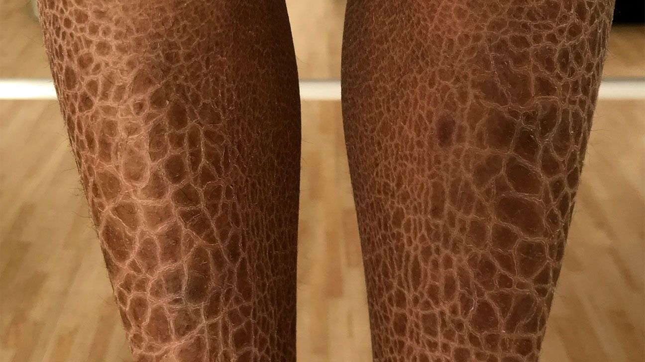 Ichthyosis vulgaris on the legs