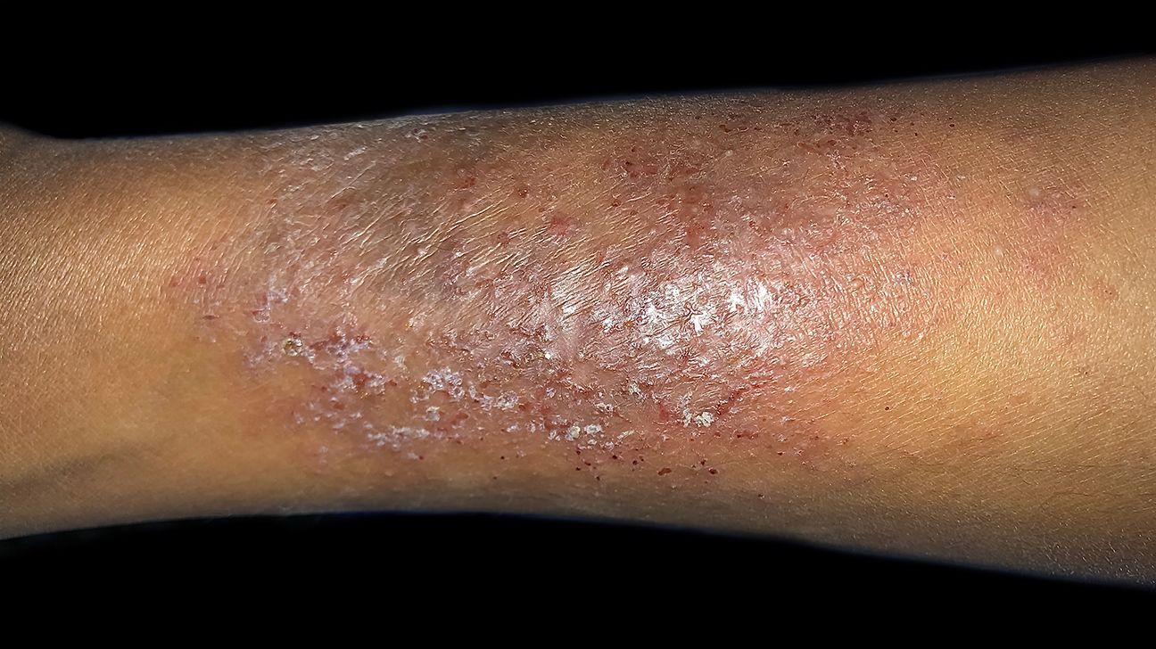 psoriasis scales on the arms