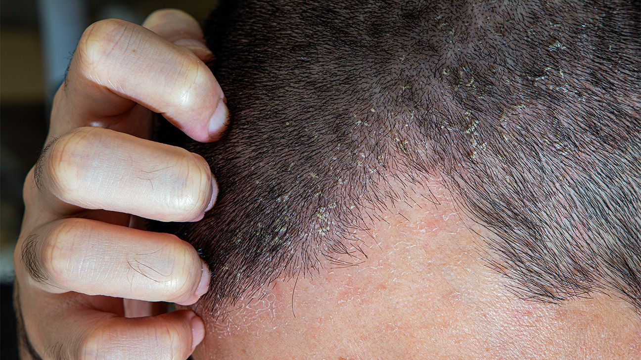 Seborrheic eczema on the scalp