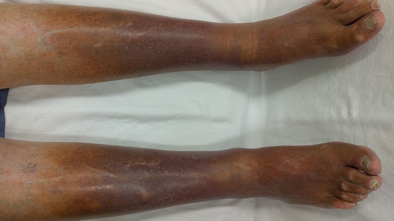 Stasis dermatitis causing swelling on the legs