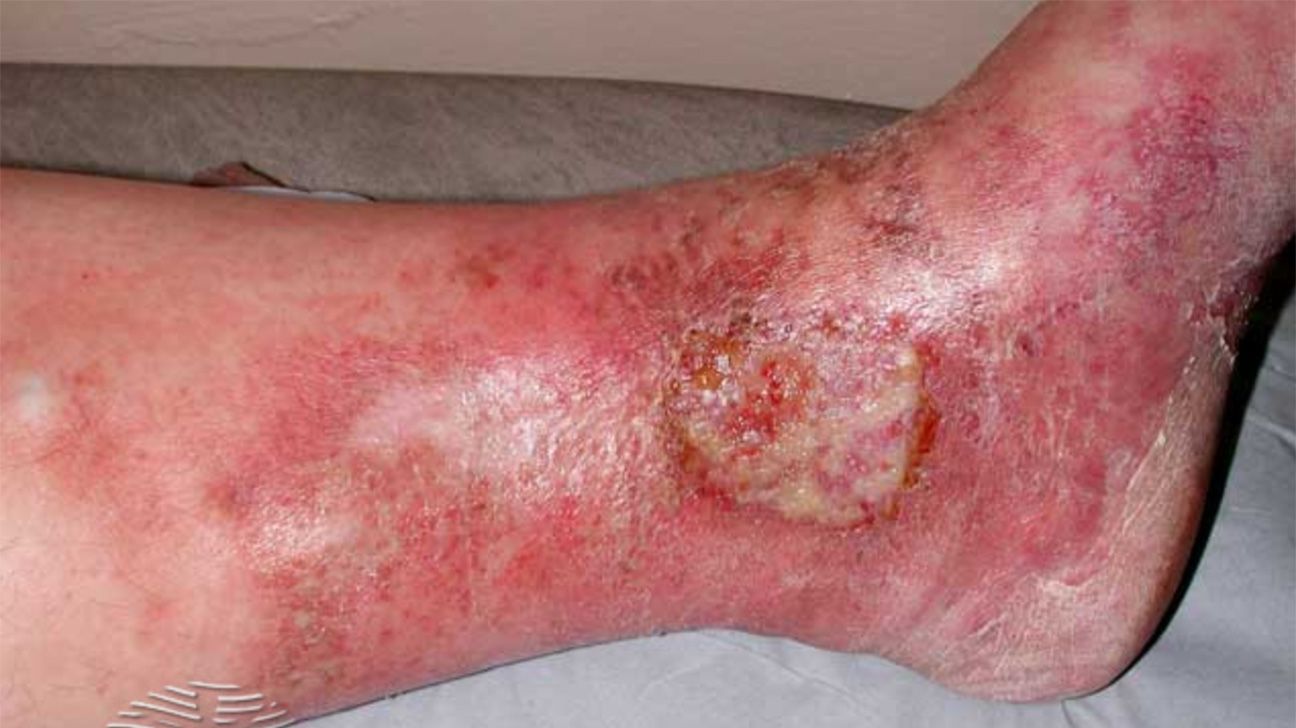 Venous stasis ulcer due to stasis dermatitis