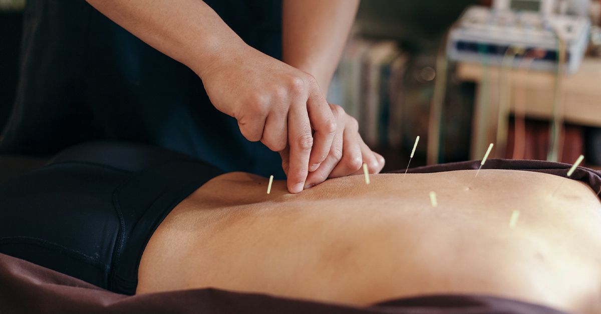 Medicare Is Acupuncture Covered for Arthritis?