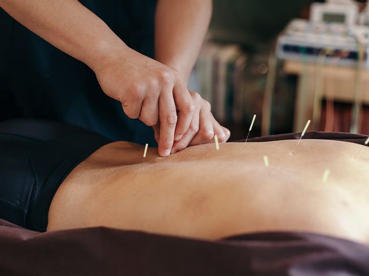 medicare-is-acupuncture-covered-for-arthritis
