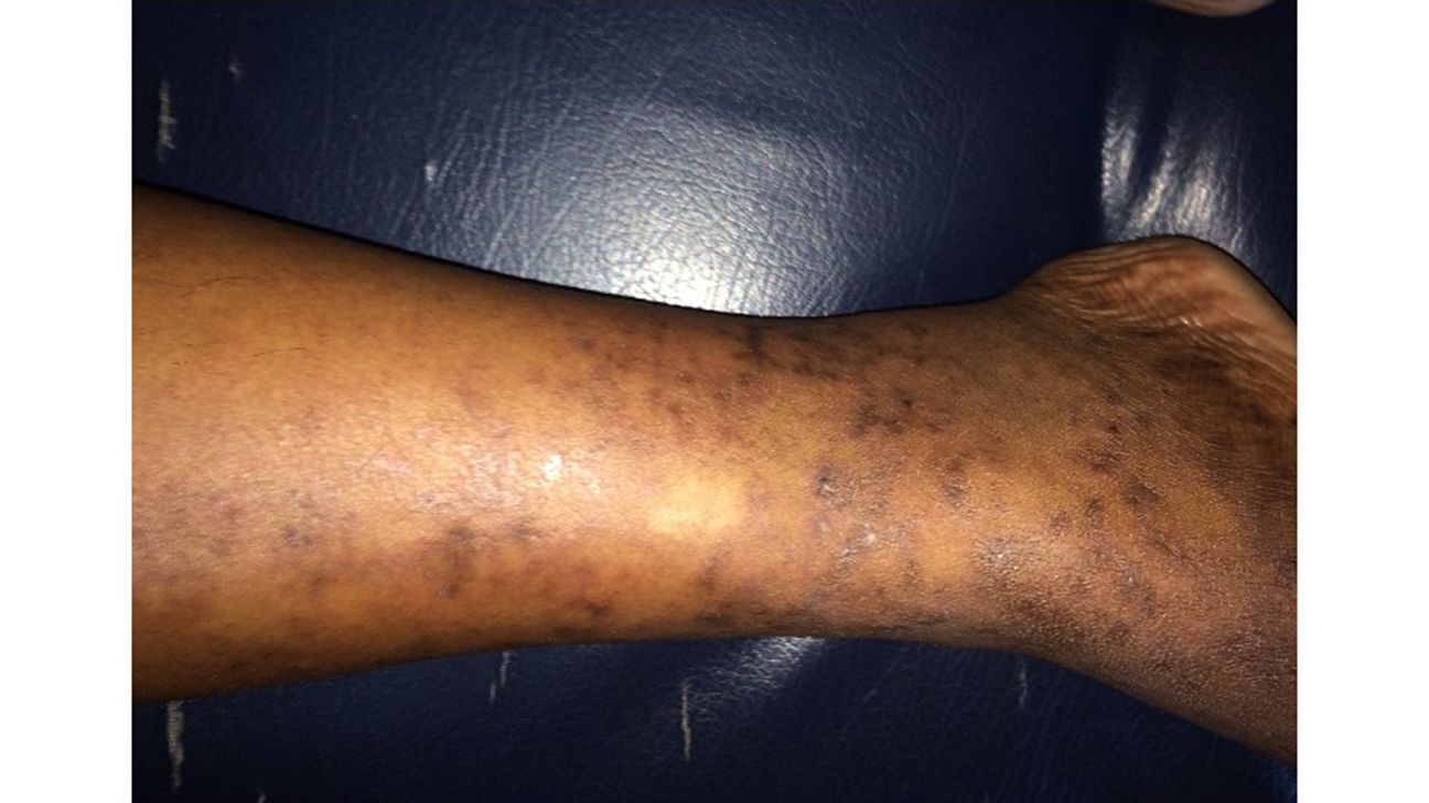 livedo reticularis rash on leg with dark skin