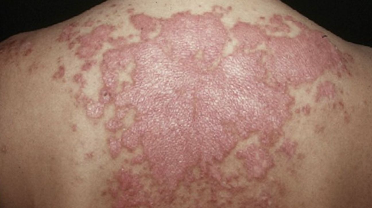 red rash from subacute cutaneous lupus erythematosus across the upper half of the back of a person with light skin