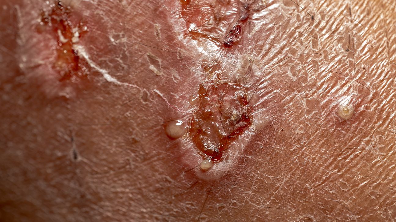 oozing discoid lupus rash on skin