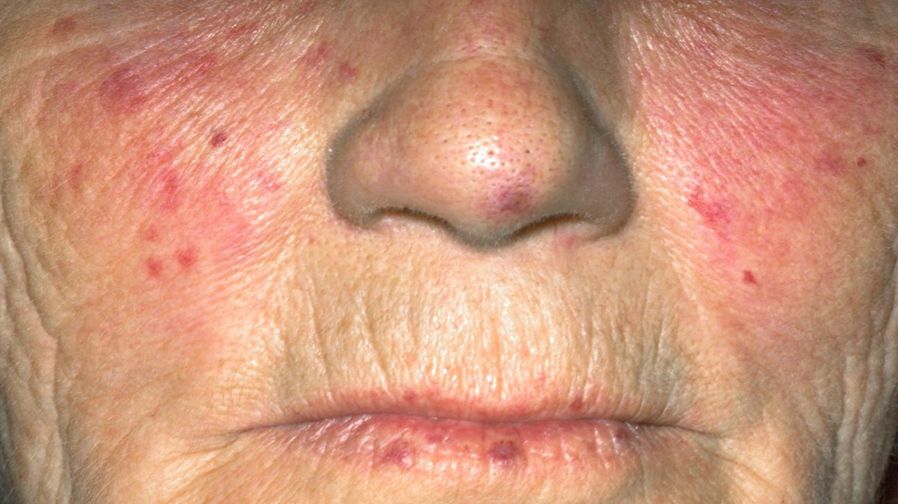 malar (butterfly) rash on the face