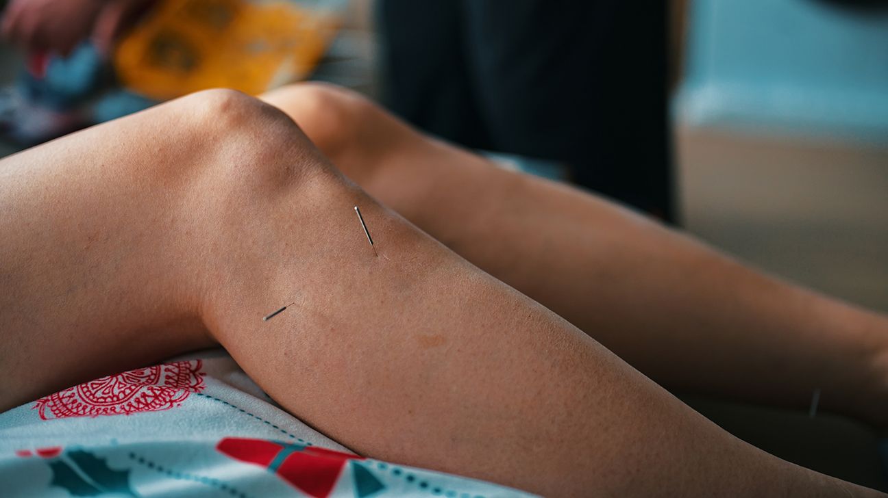 Someone getting acupuncture on their calf muscle to treat restless leg syndrome. 