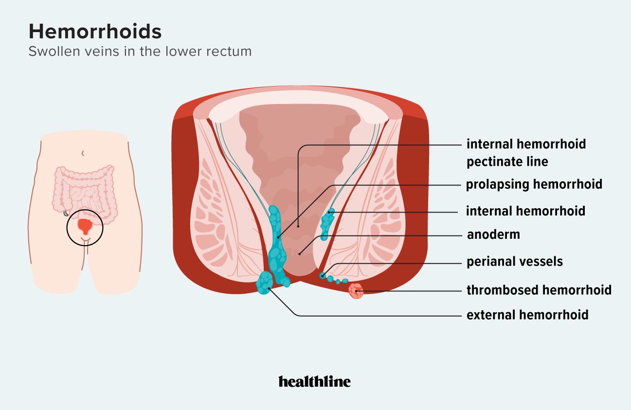 infographic of the lower rectum and hemorrhoids