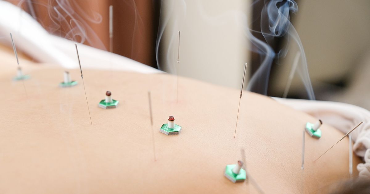 Acupuncture And Moxibustion English&Chin popular