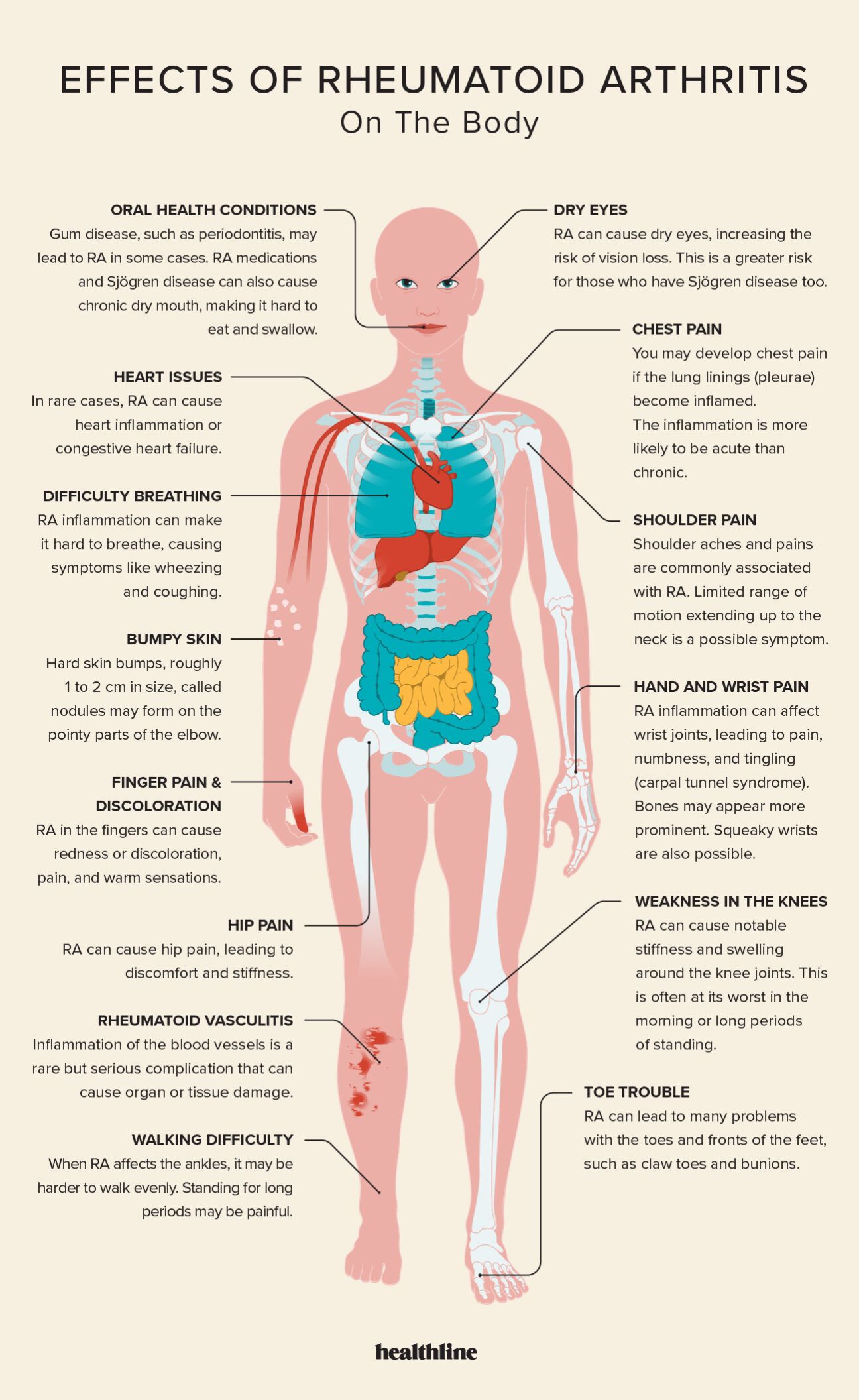 Effects of Rheumatoid Arthritis Skeletal System, Immune, More