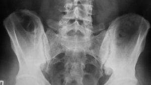 X-ray image showing ankylosing spondylitis affecting the sacroiliac joint