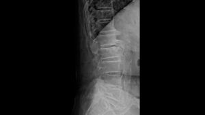 lateral view X-ray image of spine showing ankylosing spondylitis
