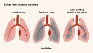 comparison of lungs of a nonsmoker, current smoker, and former smoker
