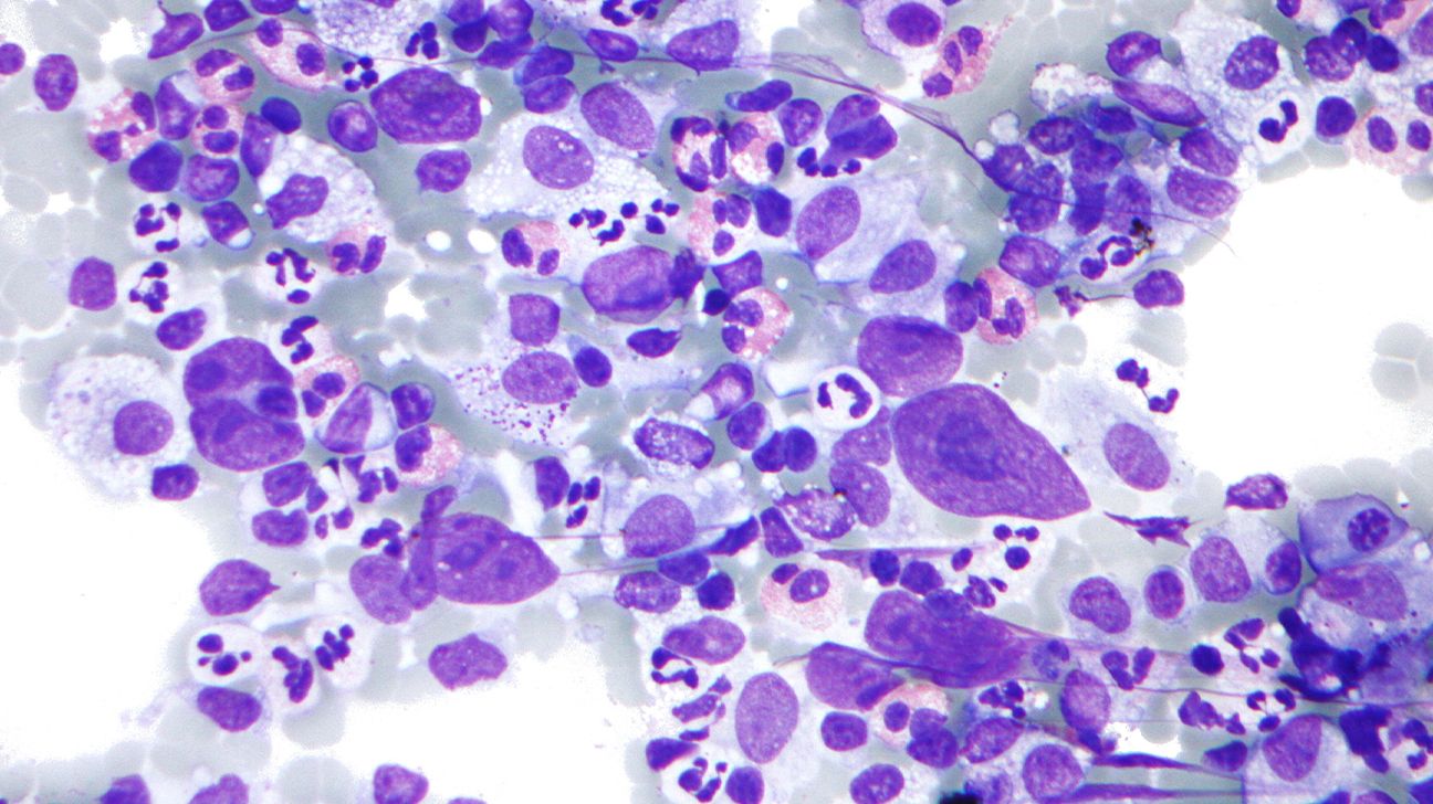 lymphoma cells under a microscope