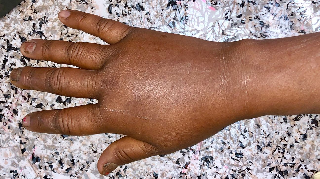 Swollen Hands 20 Causes and Treatment