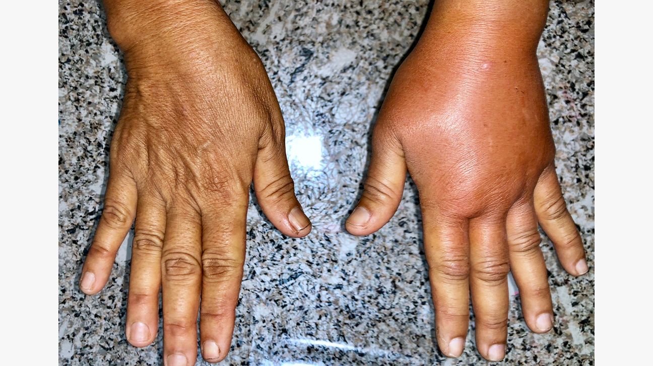 Swollen Hands 20 Causes and Treatment