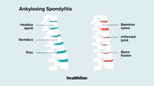 comparison of healthy spine and spine with ankylosing spondylitis