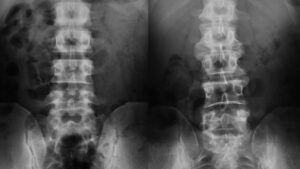 X-ray images showing comparison of health spine and spine with ankylosing spondylitis