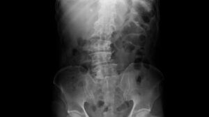 X-ray image showing ankylosing spondylitis in thoracic spine and pelvic bone