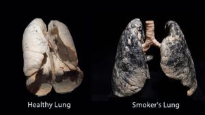 comparison of lungs of a nonsmoker and current smoker