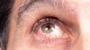 uveitis in eye