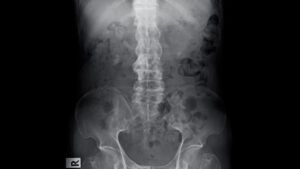 X-ray image of bamboo spine in ankylosing spondylitis