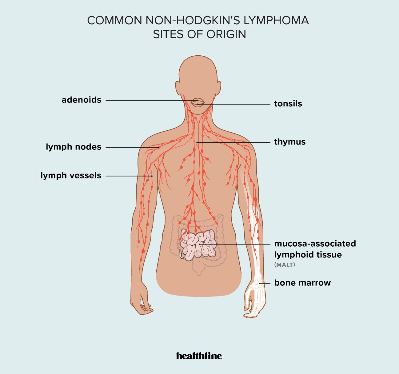 common sites of origin for non-Hodgkin's lymphoma