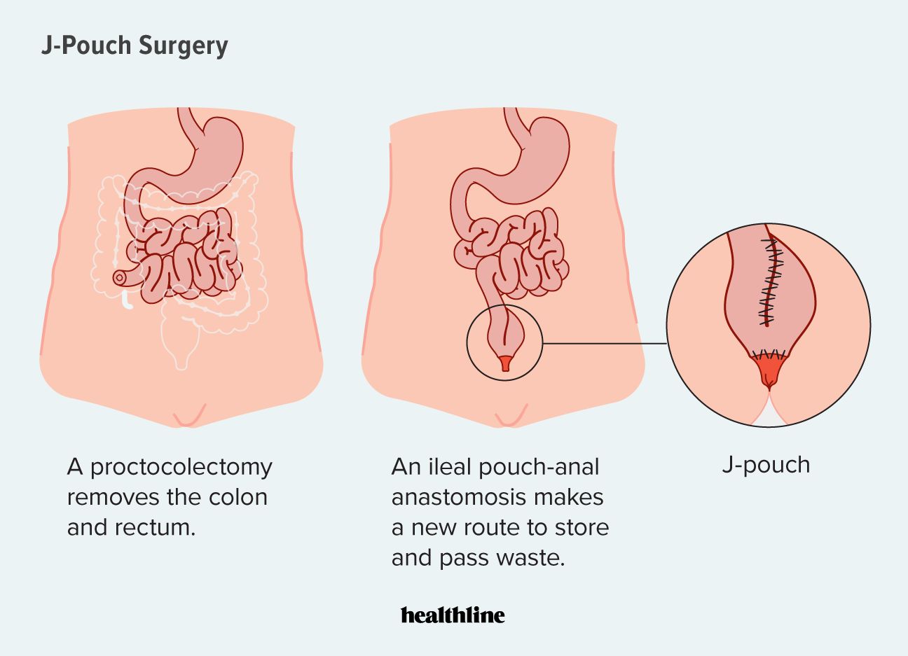 J-pouch surgery infograpic