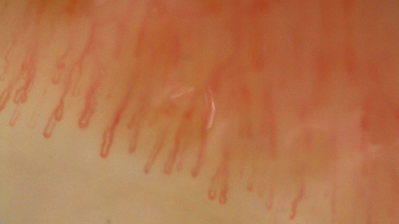 nailfold capillaroscopy