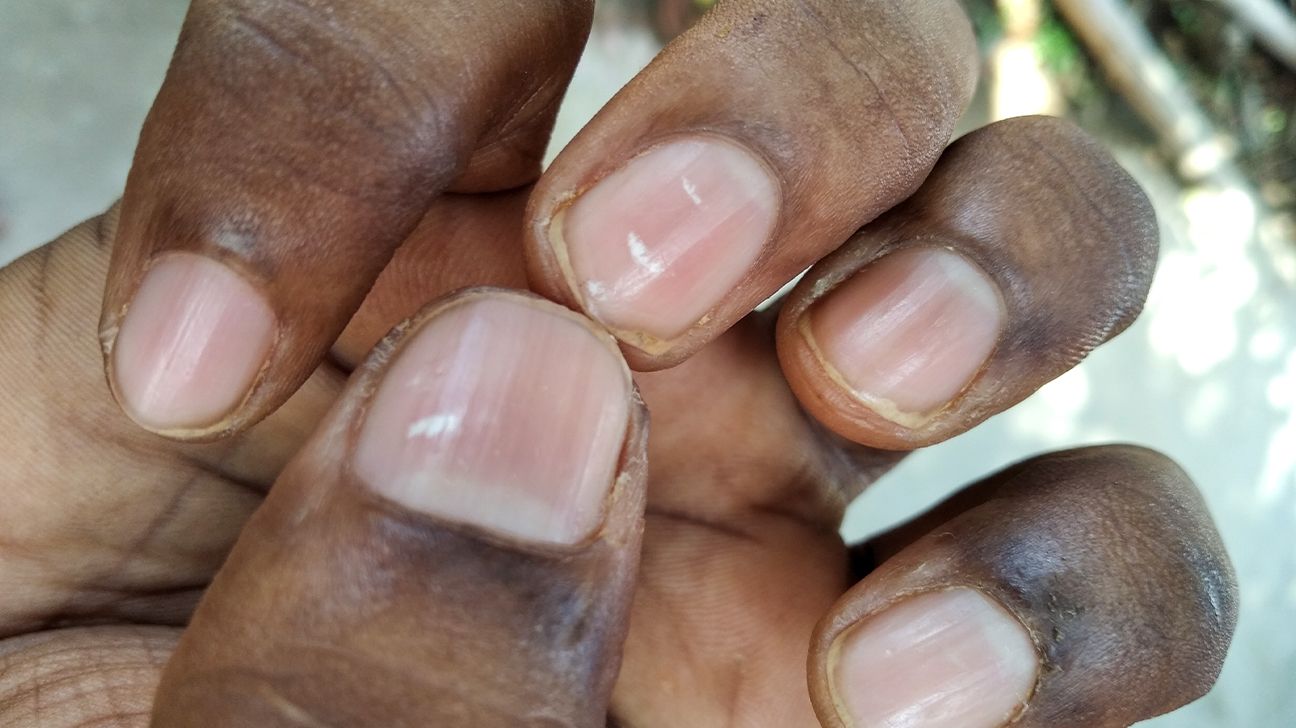 White Spots on the Nails: Potential Causes and Treatment