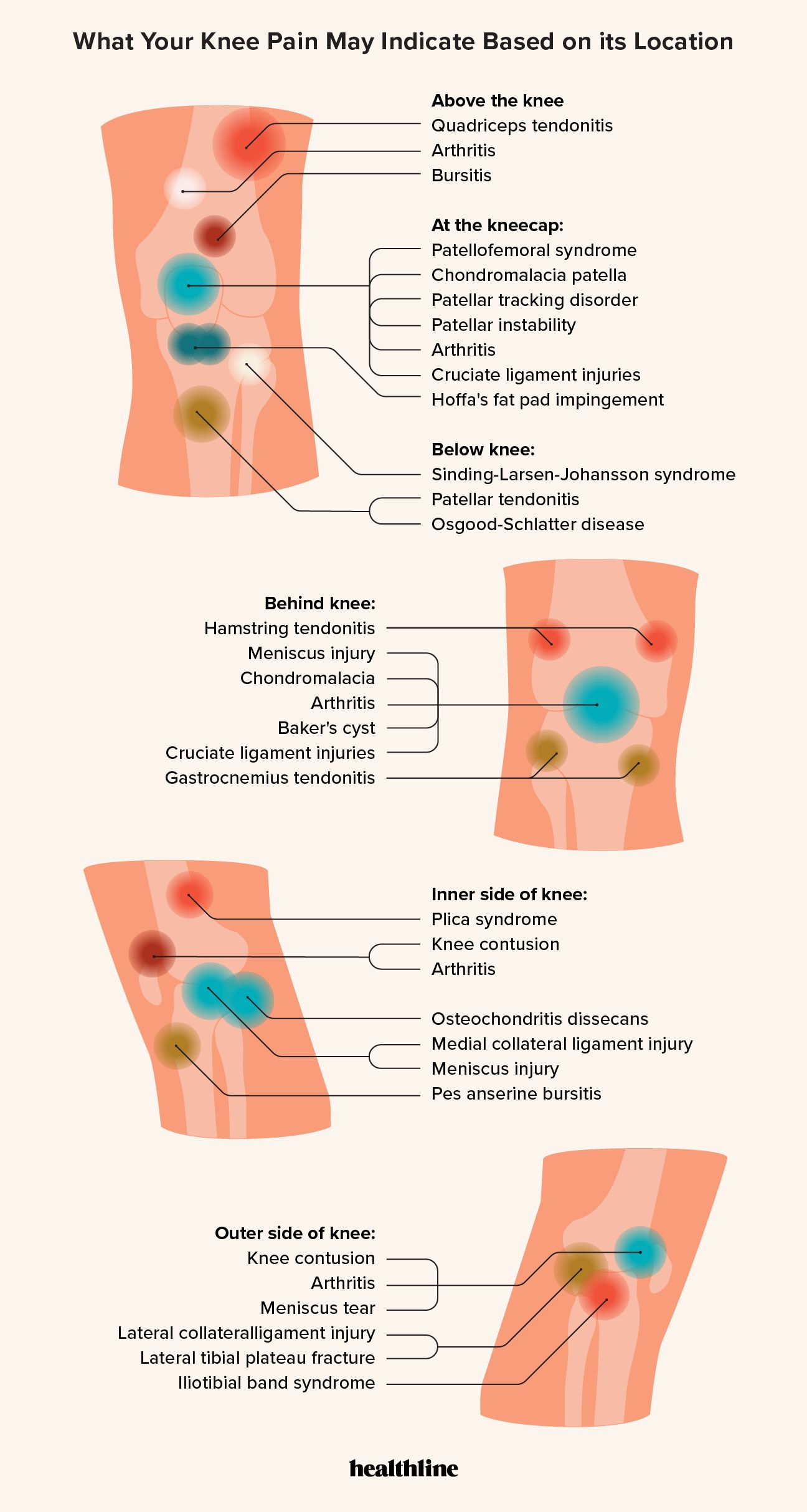 sources of pain above, below, and behind the knee, at the kneecap, and on the inner and outer sides of the knee